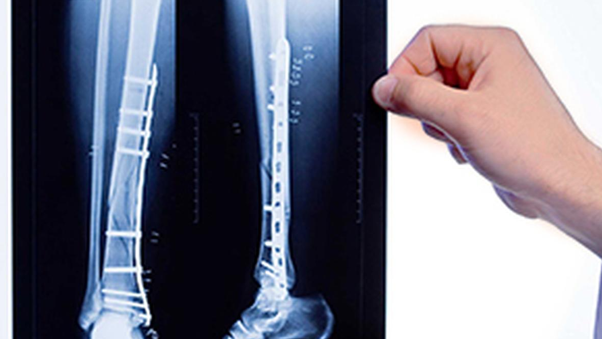 Men and Osteoporosis: Breaking the Myth Beyond Women’s Health